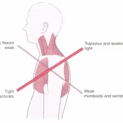 Anatomia: osłabiony mięsień czworoboczny, napięte mięśnie klatki piersiowej i karku.