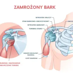 Anatomia zamrożonego barku: pogrubienie i obkurczenie torebki stawu ramiennego, z widocznymi kością ramienną, łopatką i obojczykiem.