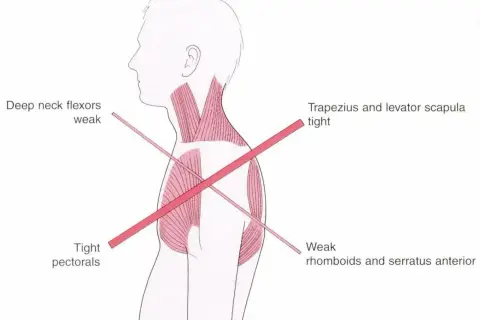 Anatomia: osłabiony mięsień czworoboczny, napięte mięśnie klatki piersiowej i karku.
