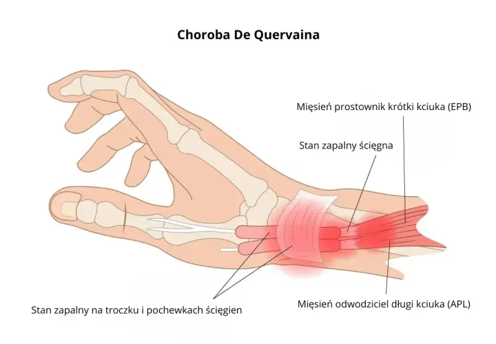 Anatomia dłoni z zaznaczonym stanem zapalnym ścięgien kciuka, wskazującym na chorobę De Quervaina. Pomocne przy ćwiczeniach na nadgarstek.