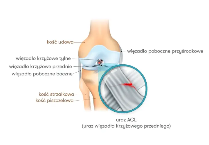Anatomia kolana z zaznaczonym urazem ACL (przedniego więzadła krzyżowego). Widoczne kości i więzadła.