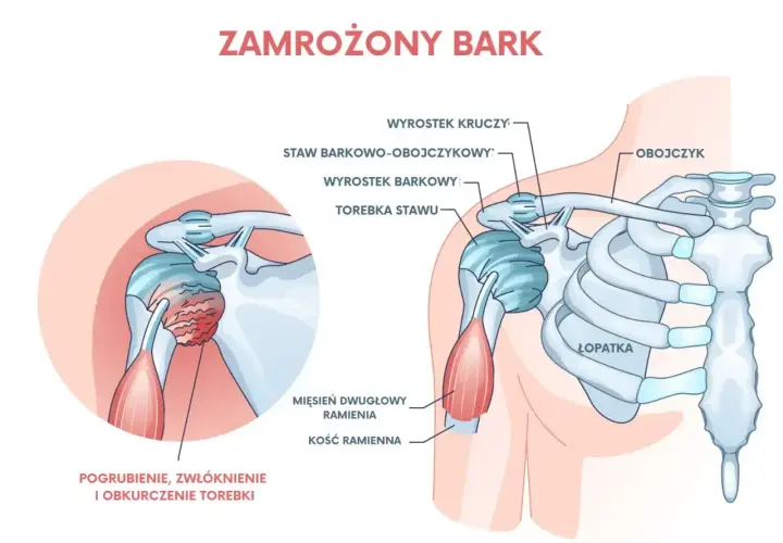 Anatomia zamrożonego barku: pogrubienie i obkurczenie torebki stawu ramiennego, z widocznymi kością ramienną, łopatką i obojczykiem.