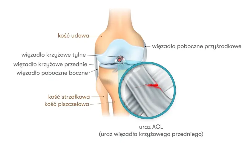 Anatomia kolana z zaznaczonym urazem ACL (przedniego więzadła krzyżowego). Widoczne kości i więzadła.