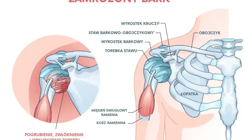 Anatomia zamrożonego barku: pogrubienie i obkurczenie torebki stawu ramiennego, z widocznymi kością ramienną, łopatką i obojczykiem.