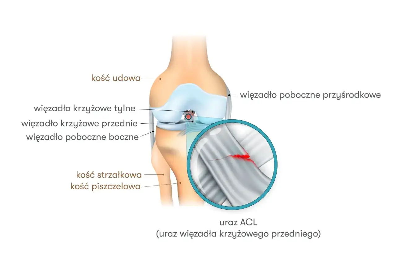 Anatomia kolana z zaznaczonym urazem ACL (przedniego więzadła krzyżowego). Widoczna jest ruptura więzadła.
