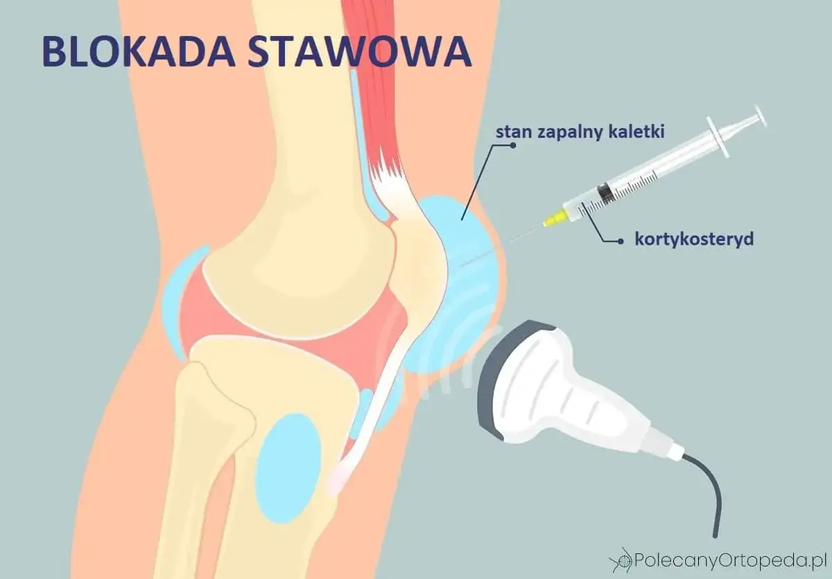 Zastrzyk blokada kolana cena: ilustracja pokazuje podanie kortykosteroidu do stanu zapalnego kaletki stawu kolanowego, pod kontrolą USG.